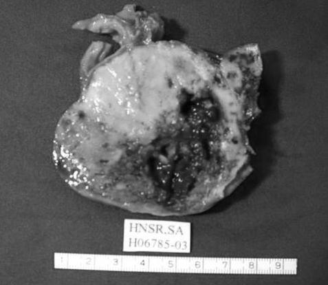 Fig. 3 - Aspecto macroscópico duma secção da peça de tumorectomia. Tumor exofítico com 13x9x7cm, de superfície lisa com zonas sólidas brancas amareladas e outras quísticas de conteúdo hemorrágico.