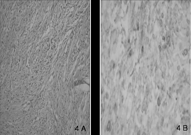 imunohistoquímico: células positivas para a vimentina e CD 117. do proto-oncogene c-kit. Esta proteína é detectada através de uma reacção imunohistoquímica com o CD117 [3].