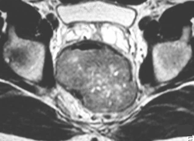 hipersinal em relação com necrose a) corte sagital e b) corte axial. b Fig. 6 - GIST da 2ª porção do duodeno em TC abdominal após administração de contraste e.v.