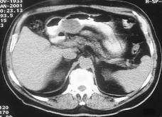 achados suportam o conceito de que a actividade da tirosinaquinase possui um papel fundamental na patogénese dos GIST [12,13].