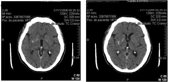 revisão relato de caso Figura 4. Tomografia Computadorizada de crânio sem contraste após trombólise intra-arterial.