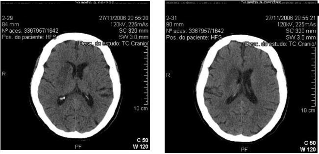 Figura 5. Tomografia Computadorizada de crânio sem contraste após 24 horas do ictus. REFERÊNCIAS BIBLIOGRÁFICAS 1.Slama M, Modeliar SS. Hypertension in the intensive care unit.