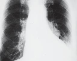 ) ngiografia mostrando grande êmbolo na bifurcação da artéria direita. Figura 4 Embolia aguda sem infarto (sinal de Westmark).