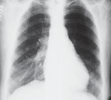 Figura 5 Radiografia em P (homem com EP). s setas mostram aumento do ramo interlobar da esquerda.