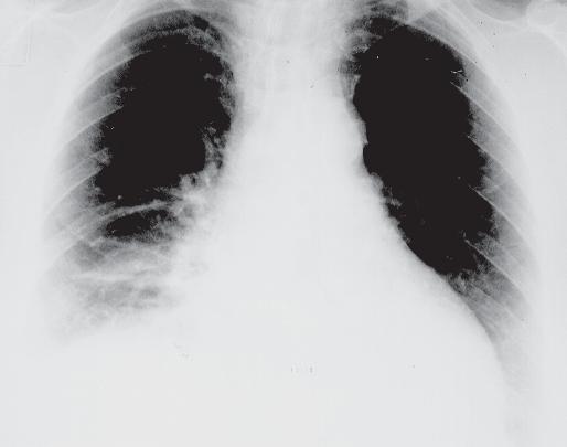 Curso de diagnóstico por imagem do tórax Figura 6 Radiografia simples do tórax em P (mulher, 55 anos com EP aguda sem infarto). Elevação do diafragma direito.
