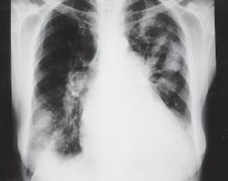 O sinal do broncograma aéreo raramente é visto na radiografia de pacientes portadores de EP aguda com infarto, o que ajuda no diagnóstico diferencial com pneumonia e outras causas de
