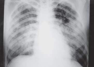 Souza Jr S Figura 10 Embolia aguda com infarto (homem, politraumatizado). radiografia em P mostra imagem lembrando edema. Figura 11 Embolia com infarto ( corcova de Hampton ).