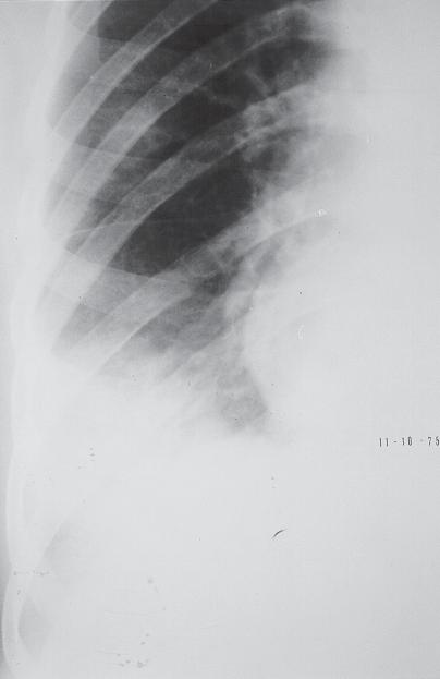 Quando o infarto se resolve, ele derrete como cubo de gelo (Figura 12), enquanto a pneumonia apresenta resolução em retalho (11).