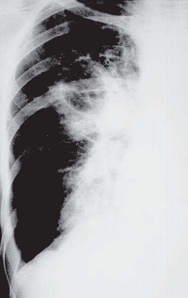 Curso de diagnóstico por imagem do tórax Figura 13 Embolia com infarto (homem, 45 anos, portador de marcapasso cardíaco).