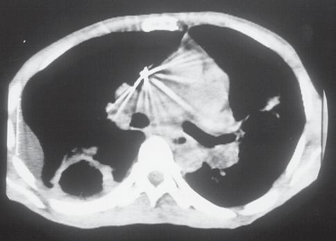 ) Tomografia do tórax, com janela para mediastino, mostrando mais detalhes da cavitação.