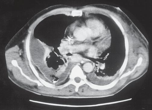 Corte obtido na região subcarinal, mostrando derrame pleural bilateral e êmbolo no ramo interlobar da esquerda.