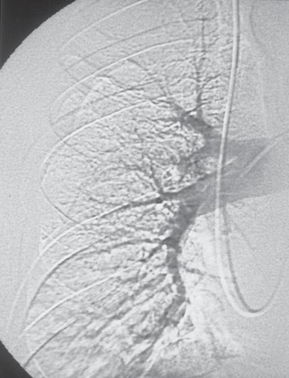 Souza Jr S Figura 17 Tomografia (homem, 63 anos, com EP sem infarto, com radiografia simples de tórax normal).