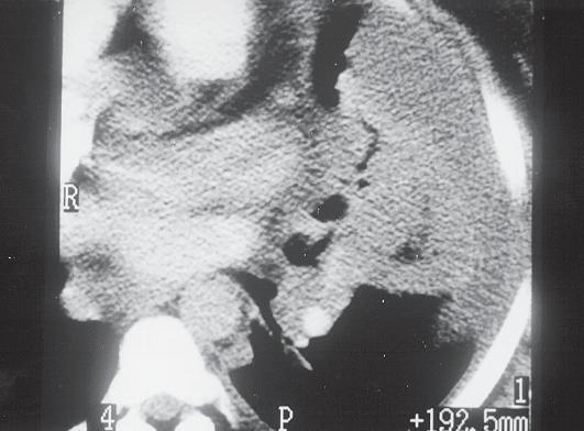 Figura 19 Tomografia com reconstrução em 2D (mulher, 35 anos, com cintilografia e radiografia do tórax normais, com forte suspeita clínica