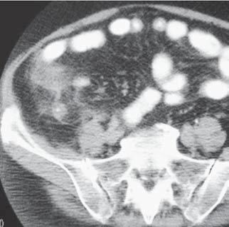 pendicite aguda complicada com abscesso na fossa ilíaca