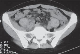 ureteral à direita (Figura 14).