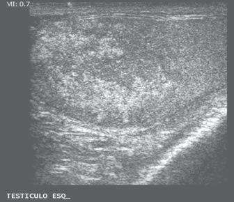 Outra complicação é a isquemia aguda gerada por compressão do pedículo vascular do cordão espermático, com conseqüente formação de trombos venosos intratesticulares.