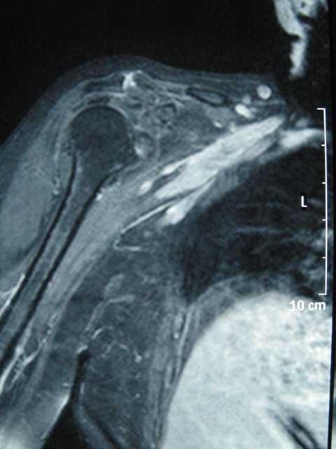 Ressonância Magnética Espessamento do plexo braquial Neoplasia?