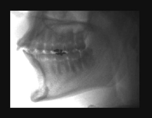 67 MATERIAL E MÉTODO Figura 4.20 Imagem preliminar, após o exame tomográfico 4.2.3) Mensuração das Inclinações Dentárias Após a aquisição das imagens, o mesmo operador fez a mensuração das inclinações dentárias, com auxílio do software QR DVT-9000.