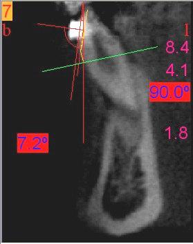 75 MATERIAL E MÉTODO Este procedimento para determinação do valor angular de inclinação dentária foi realizado para cada dente anterior (de canino direito, a canino esquerdo), superiores e