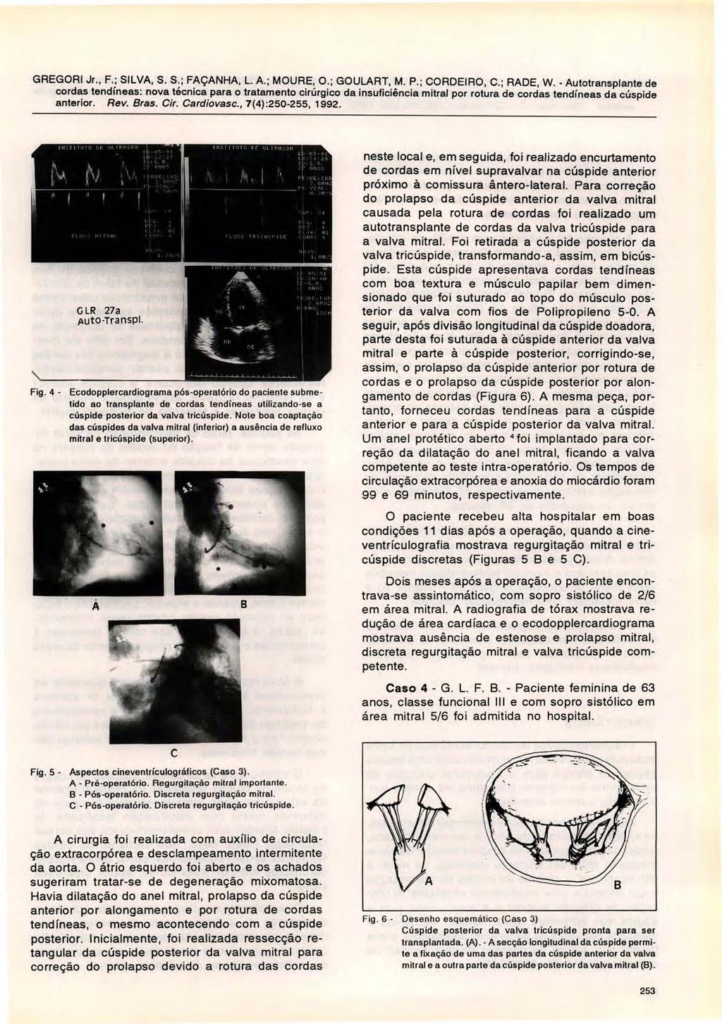 GREGORI Jr., F.; SILVA, S. S. ; FAÇANHA, L. A.; MOURE, O.; GOULART, M. P.; CORDEIRO, C.; RADE, W. - Autotransplante de anterior. Rev. Bras. Cir. Cardiovasc., 7(4) :250-255,1992. Fig.