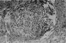 TABELA 1 - Disposição endometrial da inflamação N % Ausência de inflamação 4 10, 3 Inflamação Difusa 28 71, 8 Inflamação Focal 7 17, 9 Total 39 100, 0 Figura 5 - Agregado linfocitário Houve