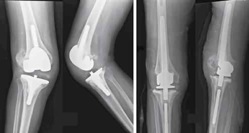 10 Em casos de grandes falhas ósseas, com perda das inserções ligamentares no fêmur ou na tíbia, insuficiências ligamentares significativas e desbalanços grosseiros entre os espaços de extensão e