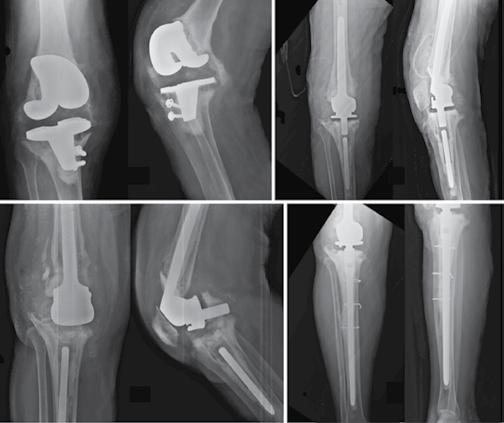 das inserções ligamentares no fêmur ou na tíbia, após retirada de artroplastia prévia do joelho, primária ou de revisão, consideradas tipo III, segundo a classificação para defeitos ósseos no joelho