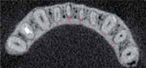 enezes, Janson G, assaro S, ambiaghi L, Garib DG No corte axial obtido, foram mensuradas as espessuras das tábuas ósseas vestibular e lingual de todos os dentes permanentes presentes (Fig. 2).