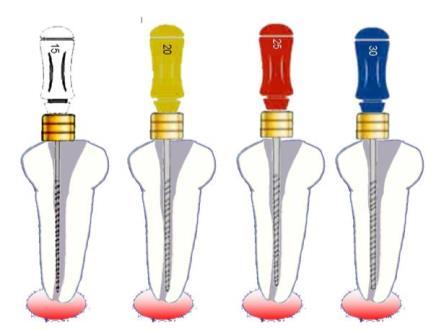 Determinar o comprimento de trabalho (CT) O CT deve ser o comprimento do dente menos 1 mm.