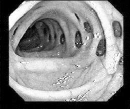 2%) das Hérnia de Littré Moléstia Diverticular dos Cólons: VERDADEIROS