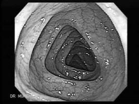 de lesões no intestino delgado Divertículos, pólipos, tumores Enema opaco Moléstia diverticular do cólon, tumores,