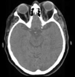 Trombose do Seio Cavernoso. A Propósito de um Caso Clínico. 39 Fig.