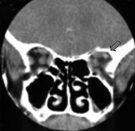 13, 14). Foram também realizados exames analíticos: Hemograma com plaquetas - normal Fig.