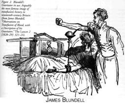9 A B FIGURA 6 6A:James Blundell (1791 1878); 6B: Ilustração de transfusão homóloga direta entre humanos.
