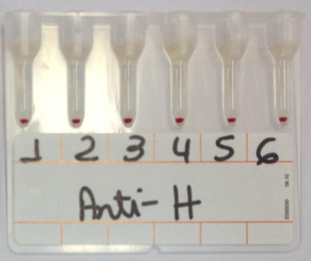 sp 1 (setas azuis); 19B: anticorpos para o sistema ABO (tipagem reversa pesquisa dos