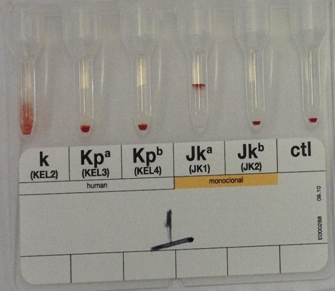 Kell (pesquisa dos antígenos Kp a e Kp b negativa no Alouatta sp 1 setas azuis); Sistema Kidd (pesquisa do