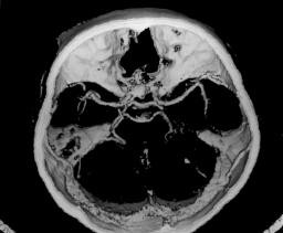 800 Arq Neuropsiquiatr 1998;56(4) Fig 2.