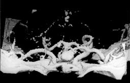 Arq Neuropsiquiatr 1998;56(4) 801 Fig 4. A angiotomografia tridimensional também desenha o aneurisma em relação ao osso ou parte deste ao longo da base do crânio.