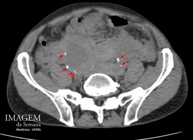 Tomografia computadorizada Análise das Imagens Imagem 1: Tomografia computadorizada da pelve, corte axial, sem meio de contraste.