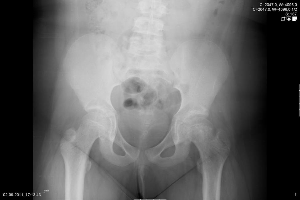 Figura 2: Epifisiólise femoral superior aguda (gentilmente cedida pelo Hospital Pediátrico de Coimbra) A crónica é a forma mais comum; os sintomas estão presentes há mais de três semanas e podem, na