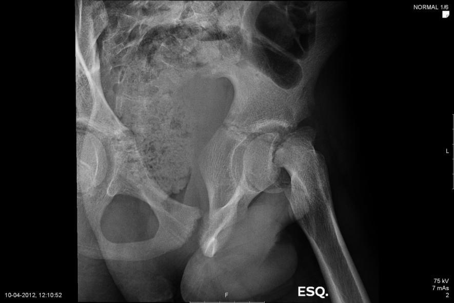 Representa a forma típica de apresentação: jovem adolescente e com obesidade, com claudicação, dor na região inguinal, na anca ou referida ao joelho, marcha em rotação externa e incapacidade de