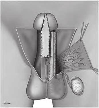 UROLOGI FUNDMENTL transformando uma hipospádia médio peniana em peno-escrotal, por exemplo.