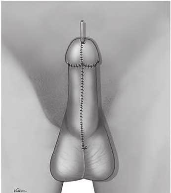 O procedimento em si consiste em, após a secção da placa e correção do chordee, criar novo leito uretral com enxerto ventral de mucosa oral (Passo 1), seguido da confecção de uretra dorsal com