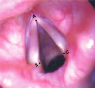 INTRODUÇÃO Lesões orgânicas secundárias, freqüentemente induzidas por fonotrauma são os nódulos de pregas vocais, responsáveis por grande parte das alterações vocais (1).