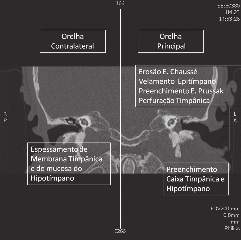 CONCLUSÃO Concluímos que a orelha contralateral apresenta alta prevalência de anomalias ao exame por TC em pacientes com OMC grave. REFERÊNCIAS Figura 2. TC coronal.