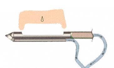 36 ANEXO 4 - ETAPAS DO PROCEDIMENTO (MAMOTOMIA) 1. Sonda inserida abaixo da lesão; 2. Vácuo acionado puxando tecido para abertura da sonda; 3. Lâmina giratória de precisão corta o tecido; 4.