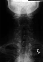 Perfil: rectificação da lordose cervical fisiológica; osteopénia difusa; aumento do espaço entre o arco anterior de C1 e a apófise odontoideia, condicionando luxação de C1/C2.