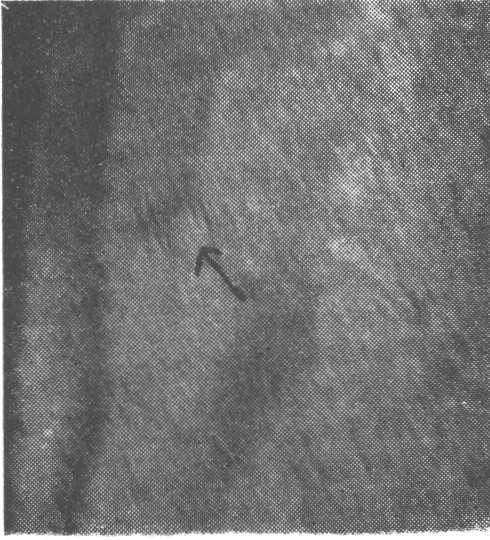 HISTOPATOLOGIA Encaminhamos uma biopsia da lesão do dorso da mão a Secção de Anatomia Patológica do Instituto de Leprologia do Serviço Nacional de Lepra, e a Dra. Lígia M.