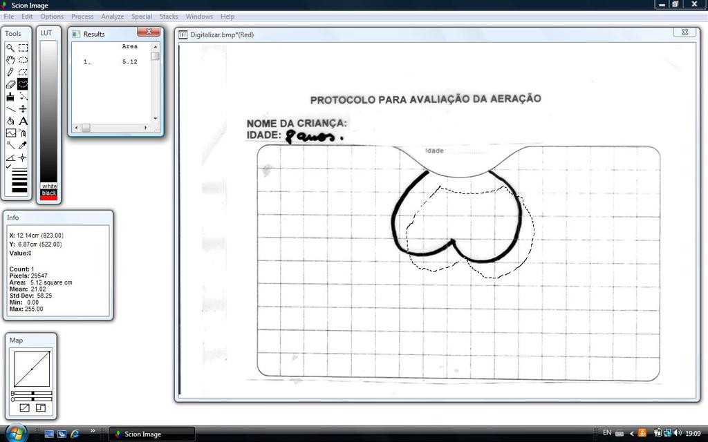 Aeração nasal em crianças asmáticas 785 Figura 1 Esboço da aeração nasal, em que o traçado contínuo representa a aferição da aeração nasal do paciente e o traçado pontilhado representa a mensuração