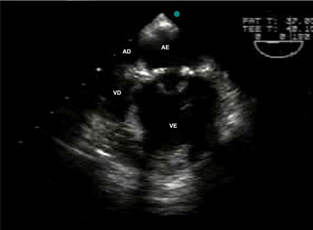 VE: ventrículo esquerdo; AE: átrio esquerdo; AD: átrio direito; VD: ventrículo direito.